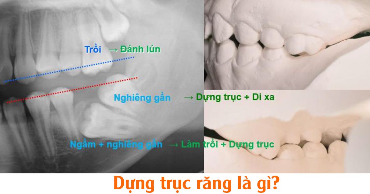 Niềng răng mặt trong