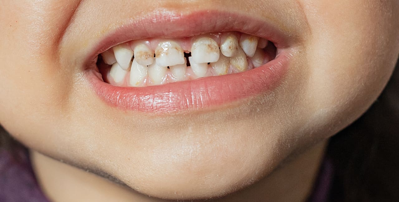 Điều trị thiểu sản men răng tại nha khoa