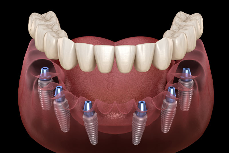 Mô hình All-on-6 implant nha khoa toàn hàm