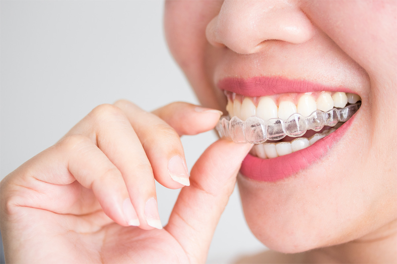 Quy trình niềng Invisalign