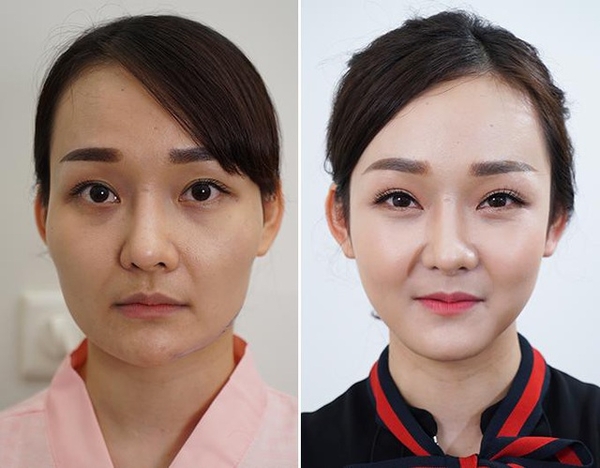 Hình ảnh trước và sau phẫu thuật hạ gò má