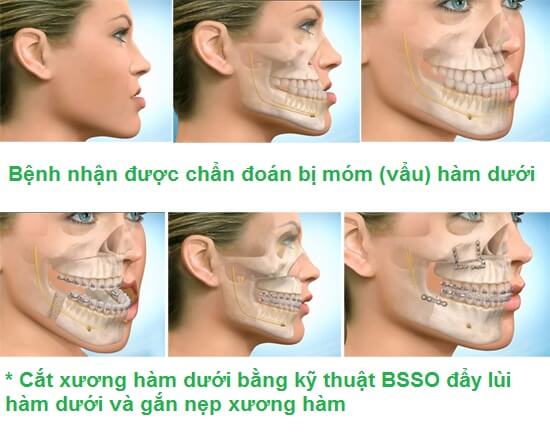 Tình trạng hàm móm thường gặp