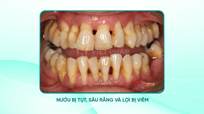Nguyên nhân tụt nướu răng