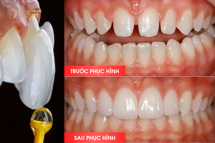 trước và sau dán veneer