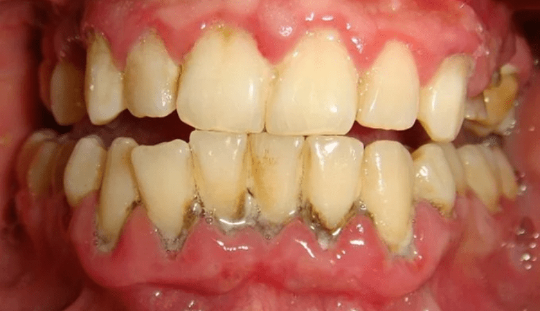 dấu hiệu viêm nướu ở tuổi dậy thì