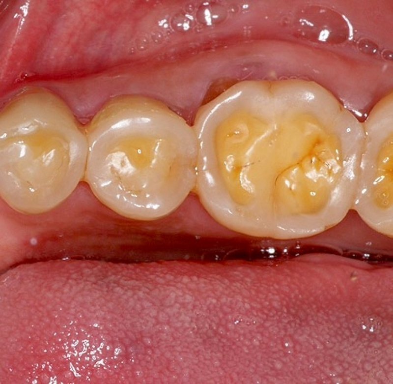 Nguyên nhân mòn cổ răng do ăn uống