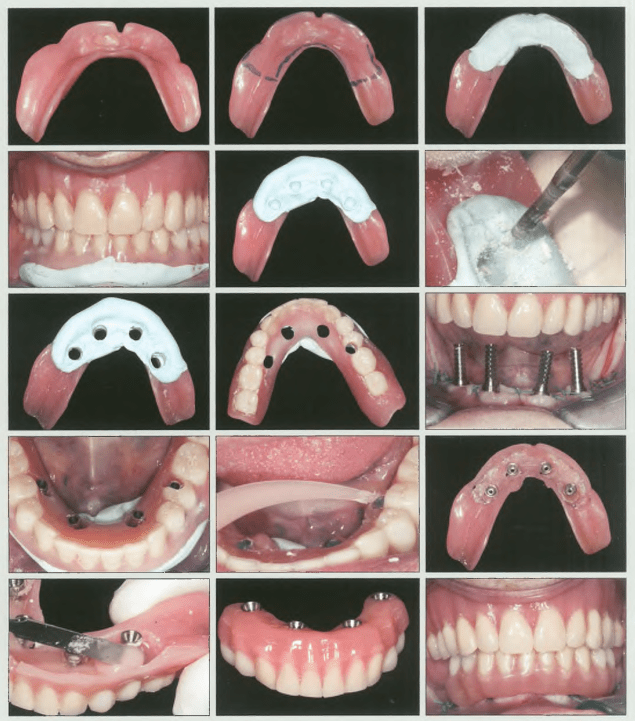 Phục hình tạm trên implant