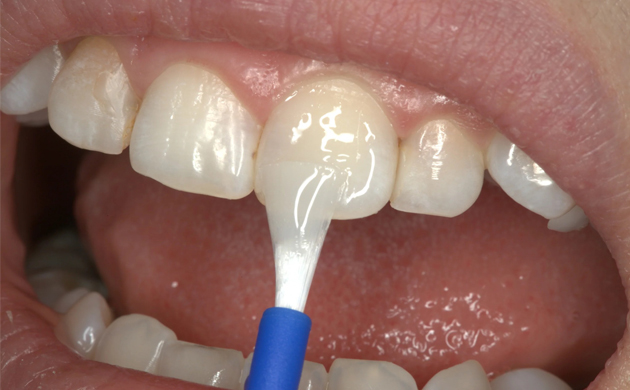 Fluoride ngừa sâu răng