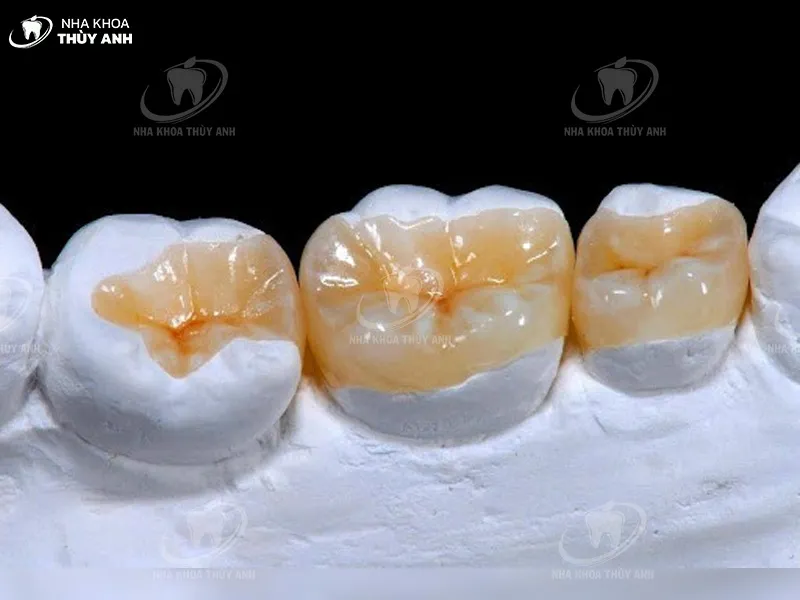 Phục hình răng sứ