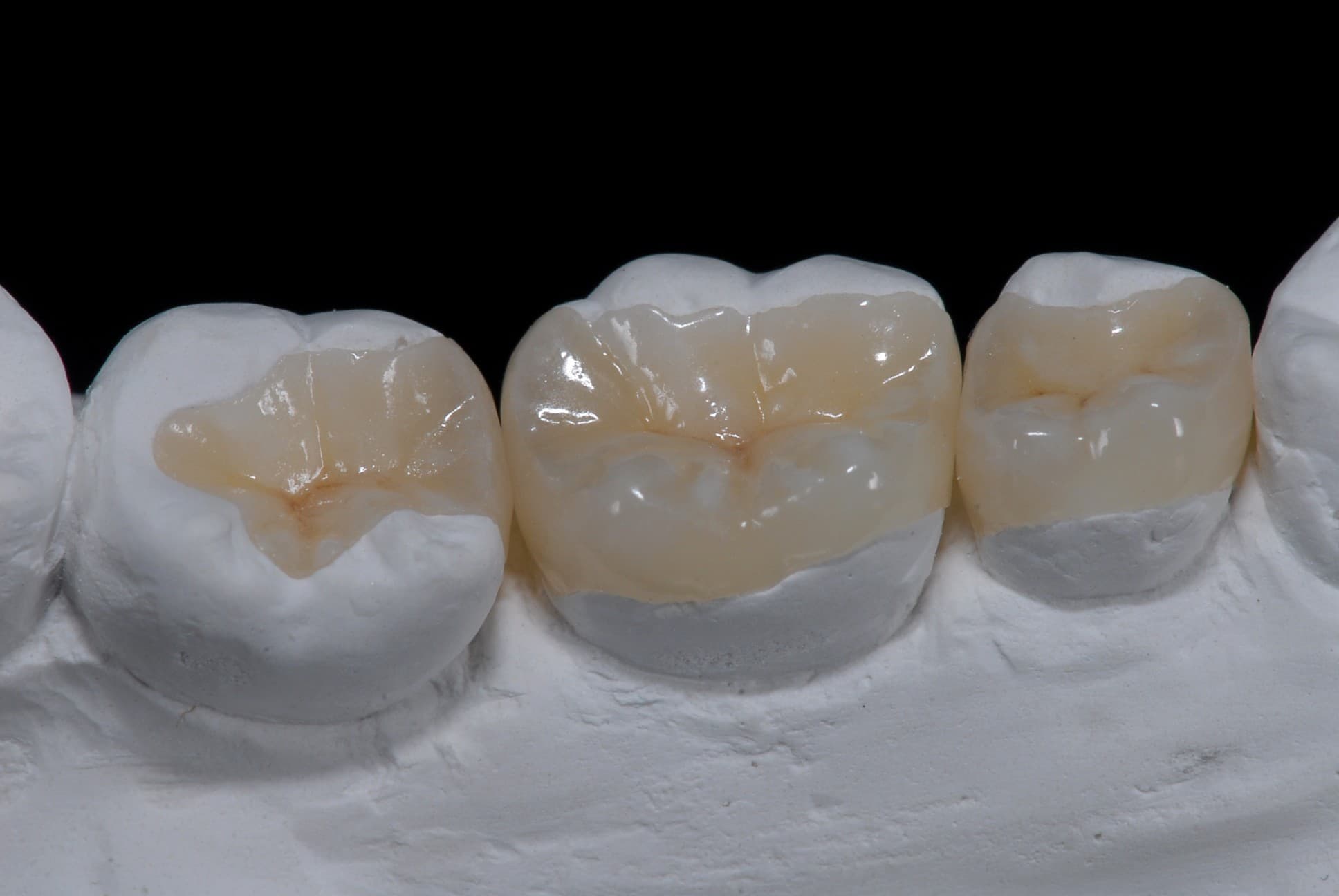 Miếng trám Overlay Sứ được chế tác và lắp vào răng
