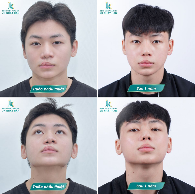 Quá trình vá môi và vòm hở hàm ếch