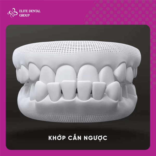 Khớp cắn ngược minh họa
