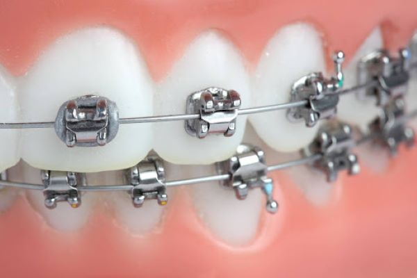 Mắc cài kim loại tự buộc