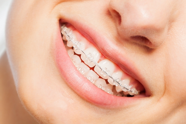 Mắc Cài Sứ Cải Thiện Chức Năng Nhai
