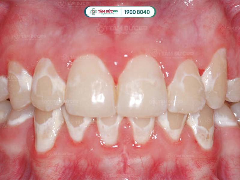 Tác hại của mảng bám răng