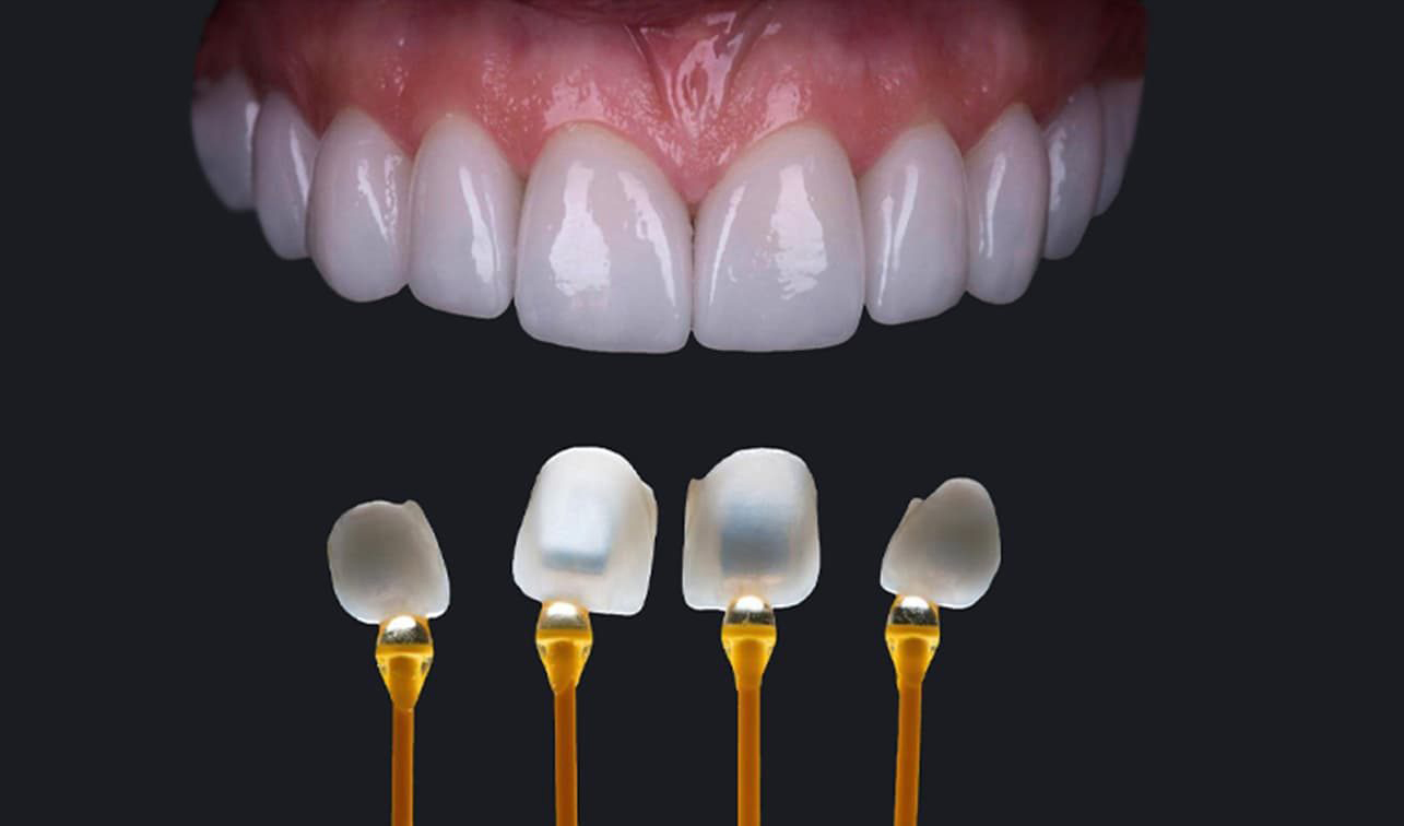 Mặt dán sứ veneer