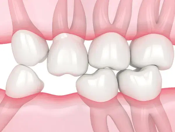 Triệu chứng và biến chứng làm trồi răng