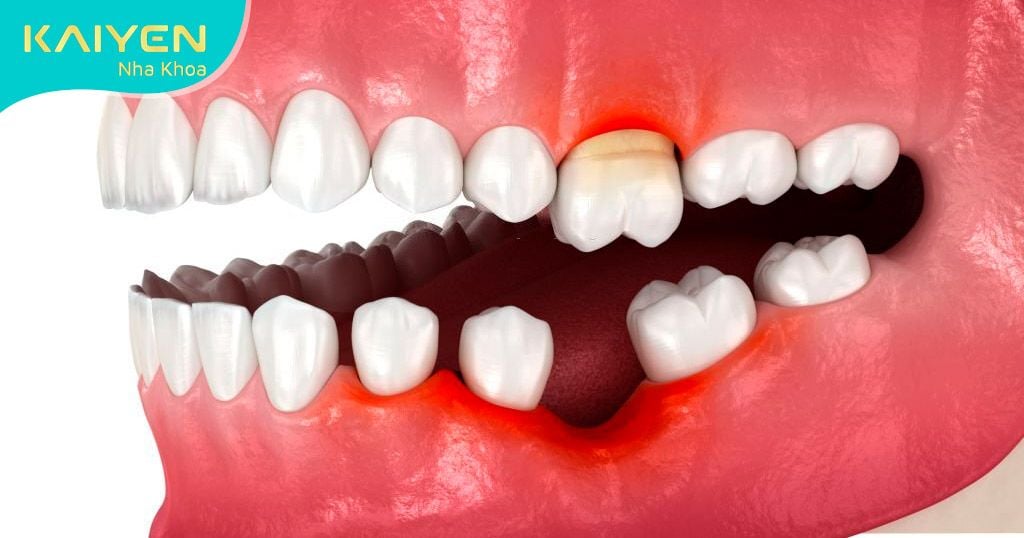 Hình ảnh minh họa làm trồi răng