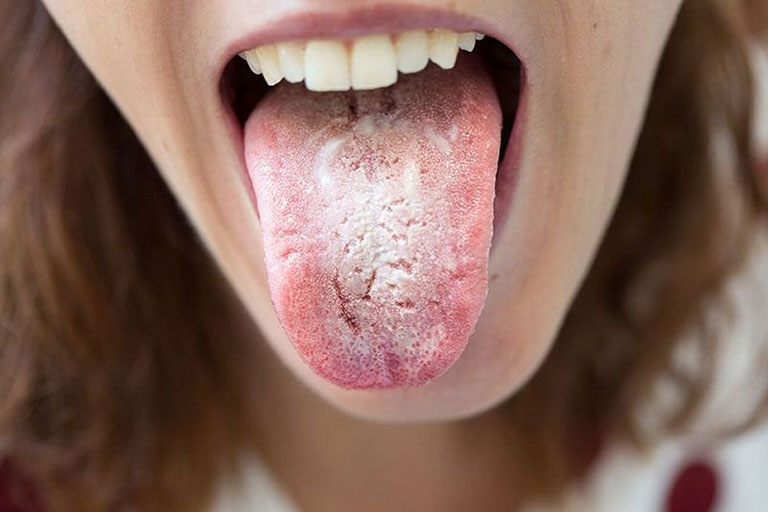 nấm miệng Candida