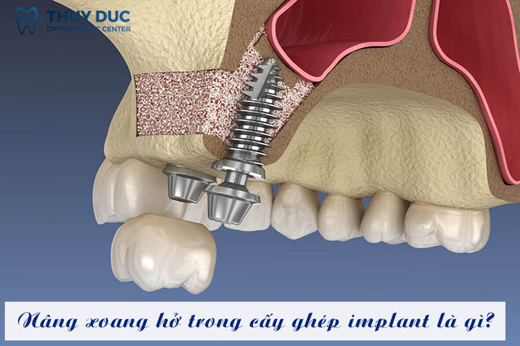 Hình ảnh minh họa phẫu thuật nâng xoang hở