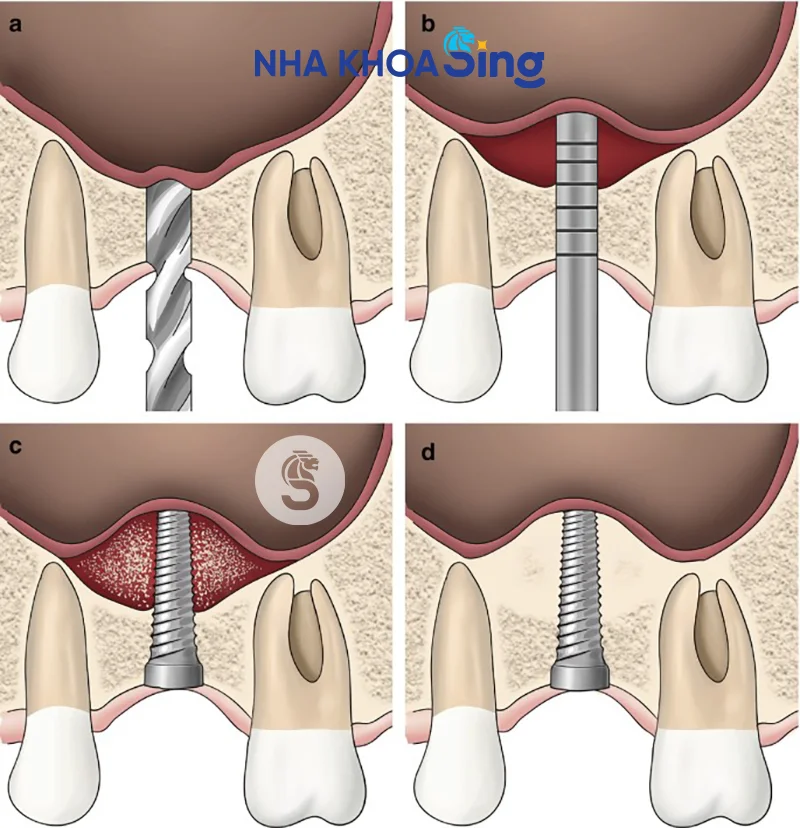 Lợi ích nâng xoang kín