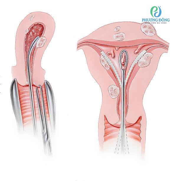Sinh Thiết Niêm Mạc – Lấy Mẫu Mô