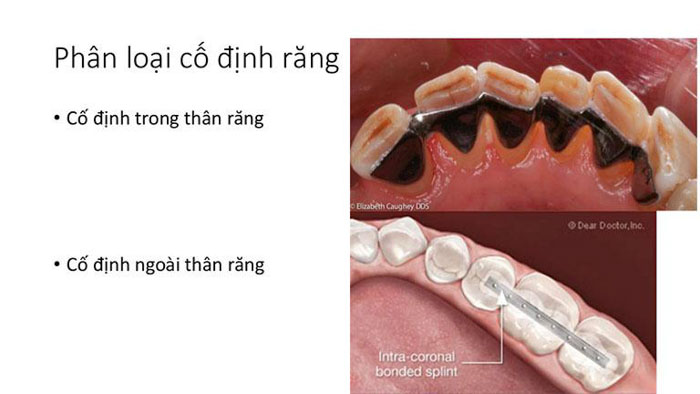 Cố định răng lung lay bằng splinting