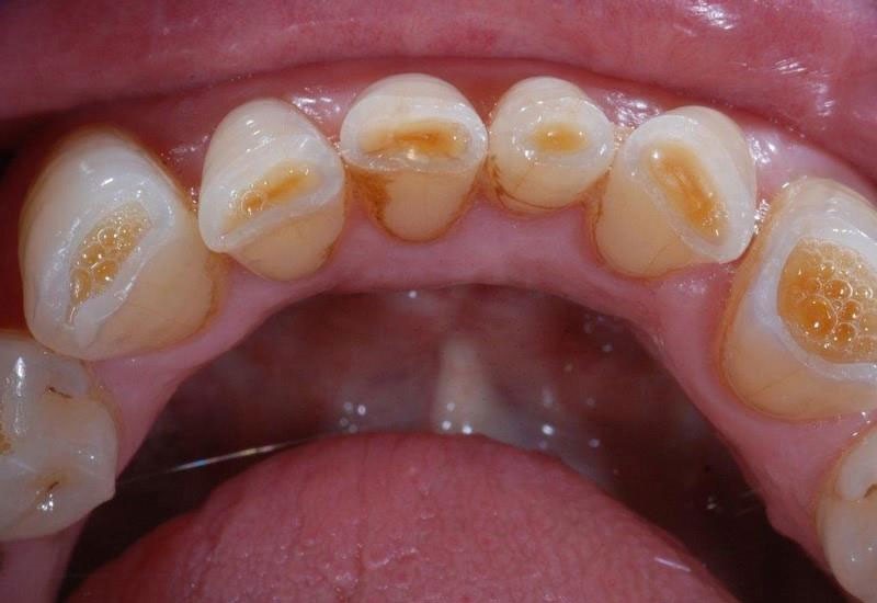 Tác hại của nghiến răng gây mòn răng