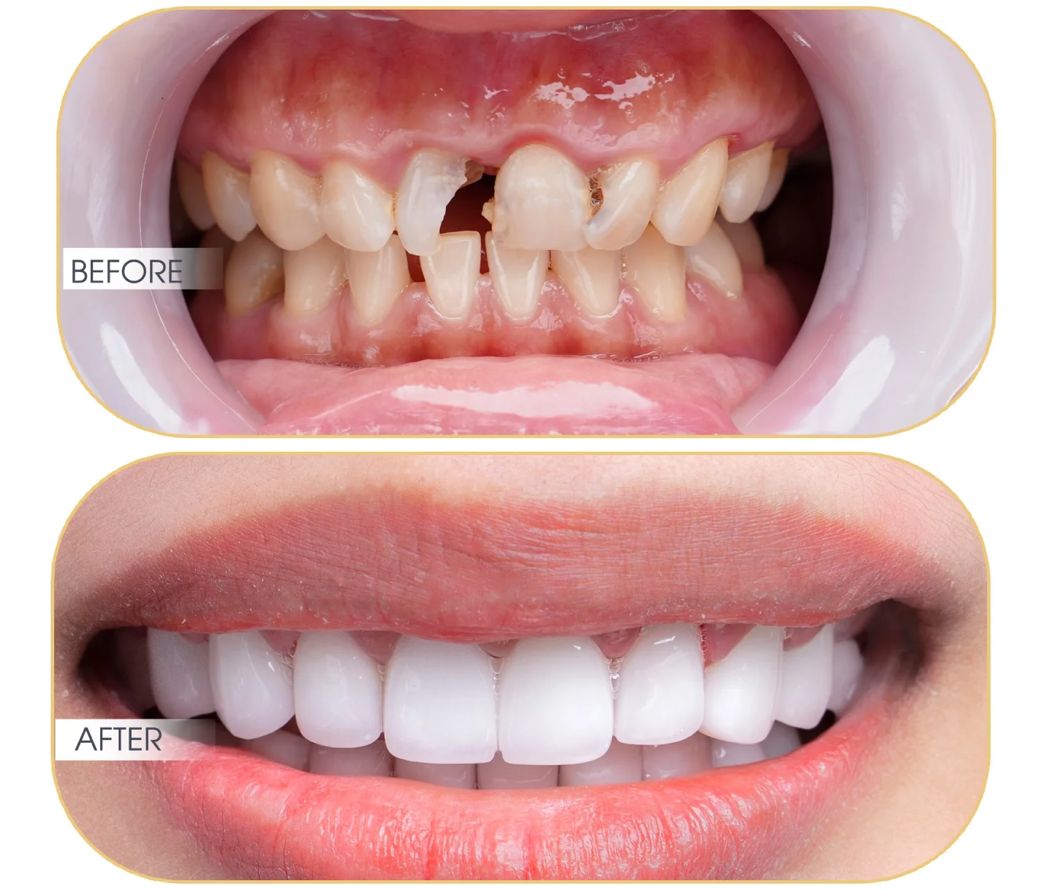 Trường hợp không nên bọc răng sứ