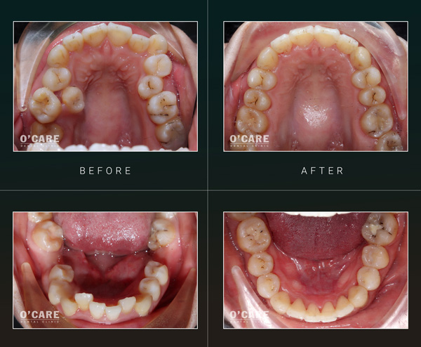 Niềng răng chen chúc khấp khểnh