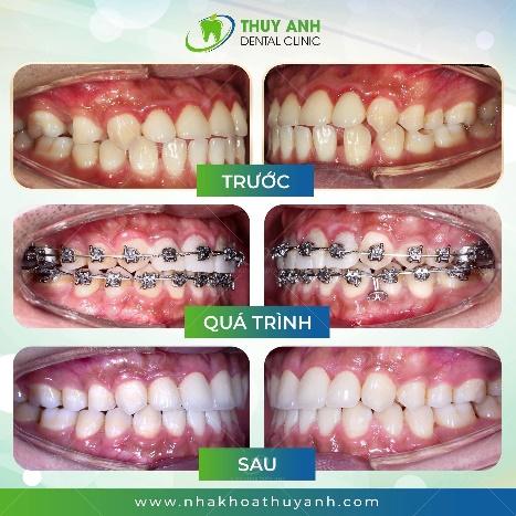 Niềng răng đóng khe thưa