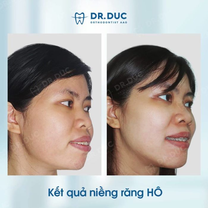 Niềng răng hô mắc cài kim loại