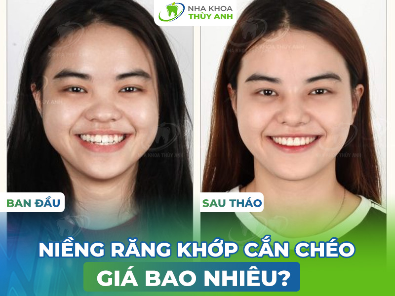 Niềng răng khớp cắn chéo giá bao nhiêu