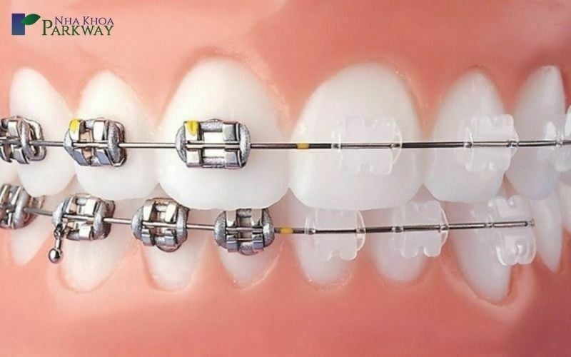 Niềng răng tự buộc là gì