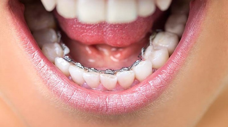 Niềng răng mặt trong - vệ sinh