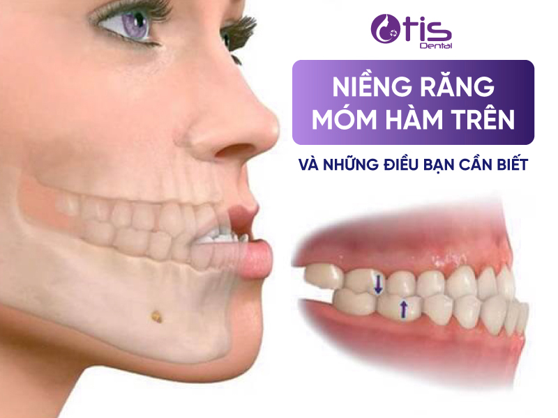 Niềng răng móm