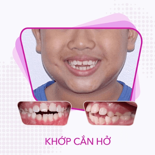 Khớp cắn hở