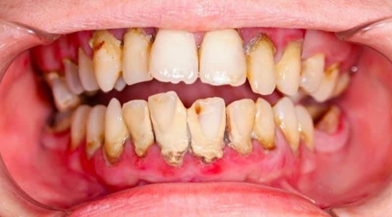 Bệnh nha chu ảnh hưởng đến nướu và răng
