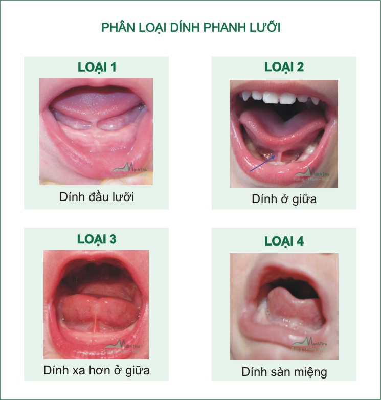 Hình minh họa phanh lưỡi ở trẻ