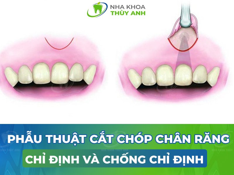 Quy trình cắt chóp răng trong nha khoa