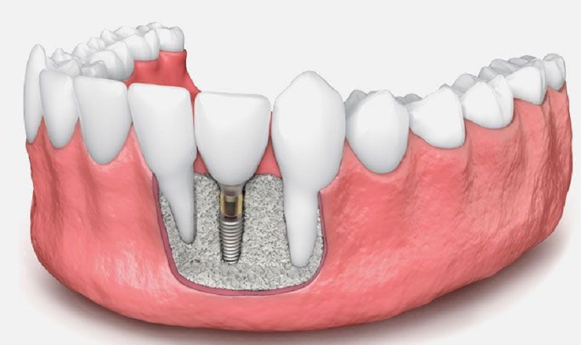 Ghép xương tự thân