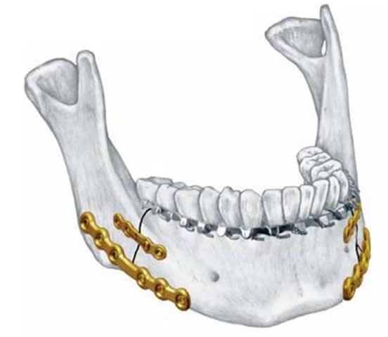 Phẫu thuật nẹp cố định xương hàm