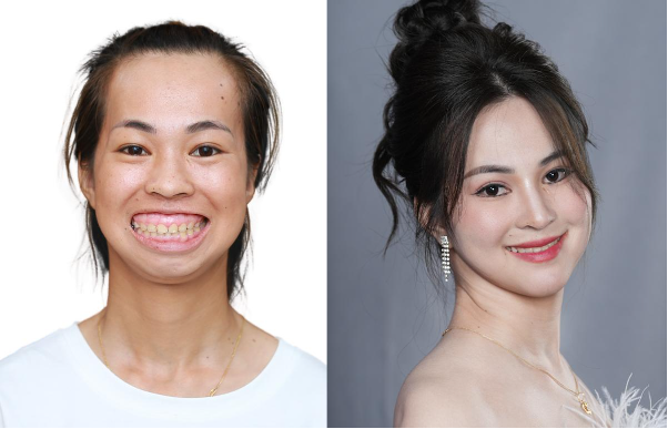 Niềng Răng Hô