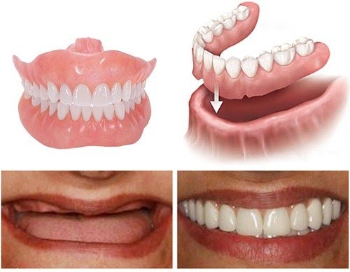 Hàm giả tháo lắp toàn hàm
