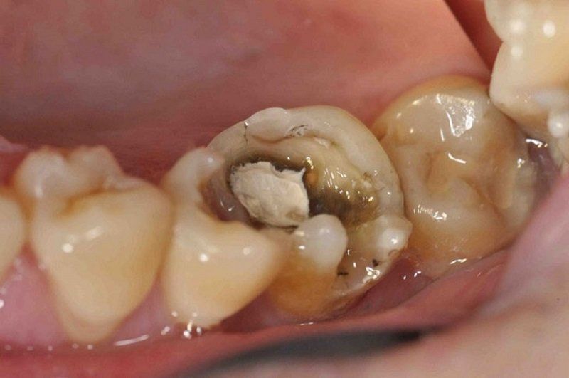 Răng bị sâu gây hoại tử tủy răng