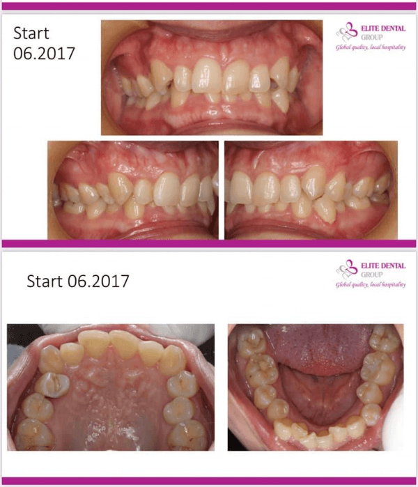 Răng mọc chen chúc mất thẩm mỹ