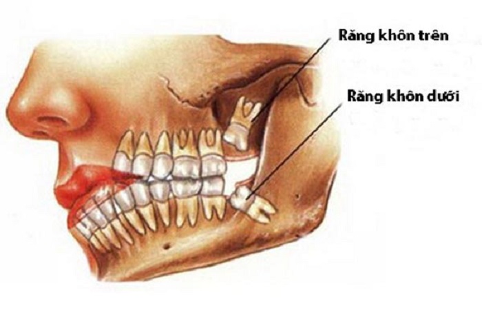 Hình ảnh minh họa răng khôn là gì