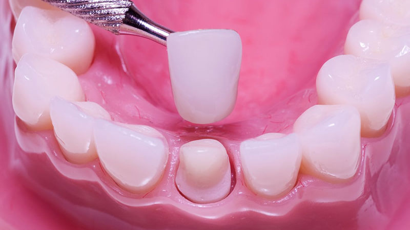 Các loại răng sứ thẩm mỹ
