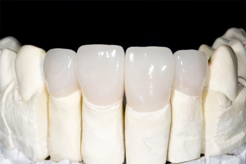 Răng Sứ Zirconia cao cấp