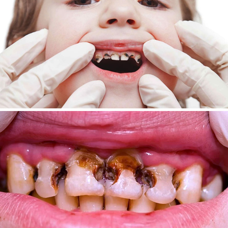 Hình ảnh sâu răng ở trẻ em